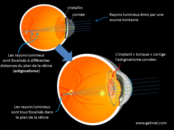 chirurgie de l'astigmatisme par un implant torique  principes et représentation
