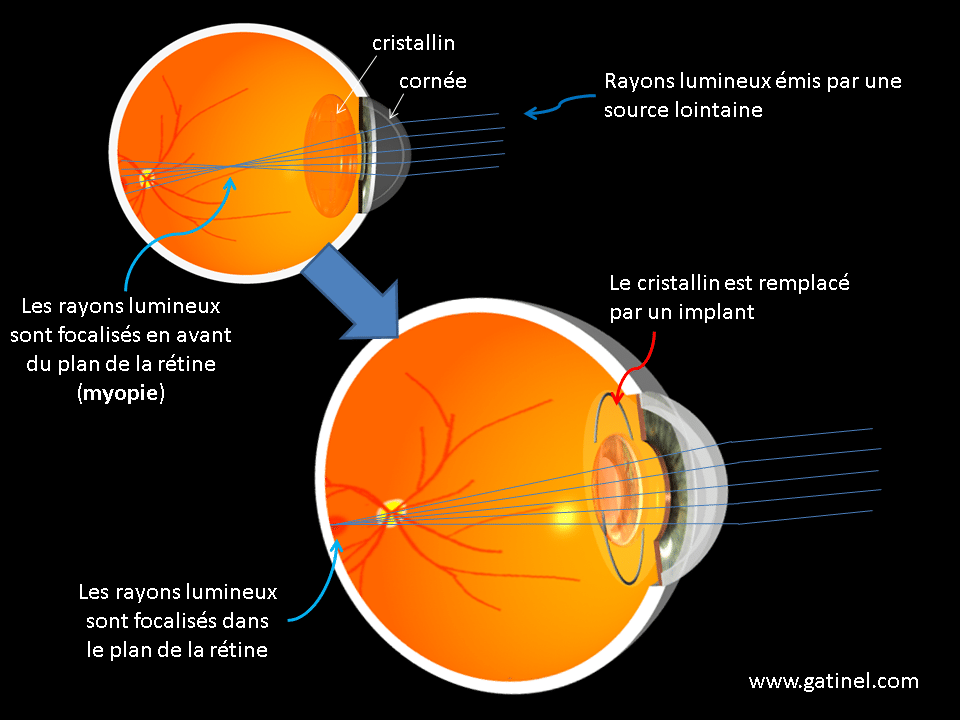 Chirurgie de la myopie - laser LASIK implants