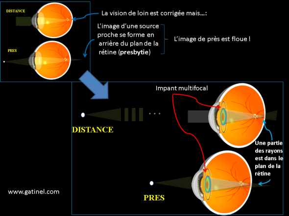 chirurgie de la presbytie par pose d'un implant multifocal en remplacement du cristallin