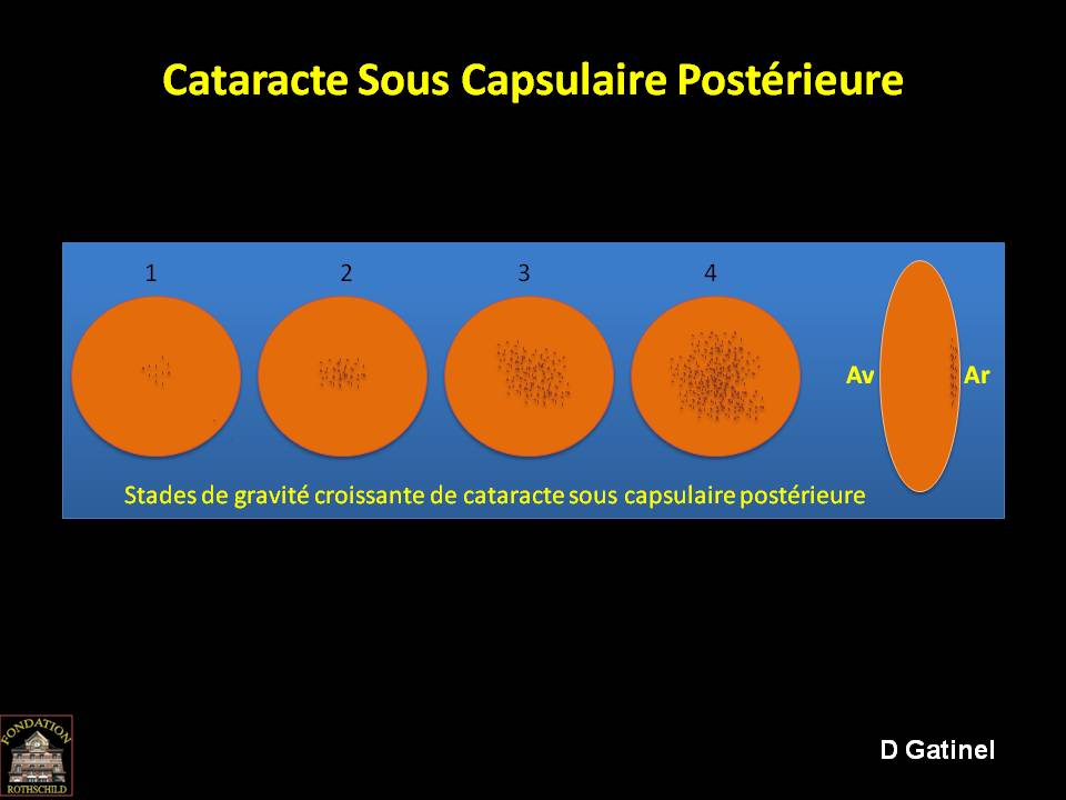 Qu'est-ce qu'une cataracte sous capsulaire? - Docteur Damien Gatinel