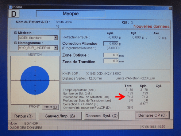 laser Nidek EC5000  ablation myopie 6 dioptries