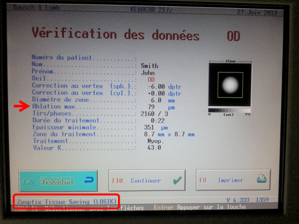 Simulation de correction de la myopie (6 Dioptries) en mode "Tissu saving": l'ablation centrale requise est de 79 microns.