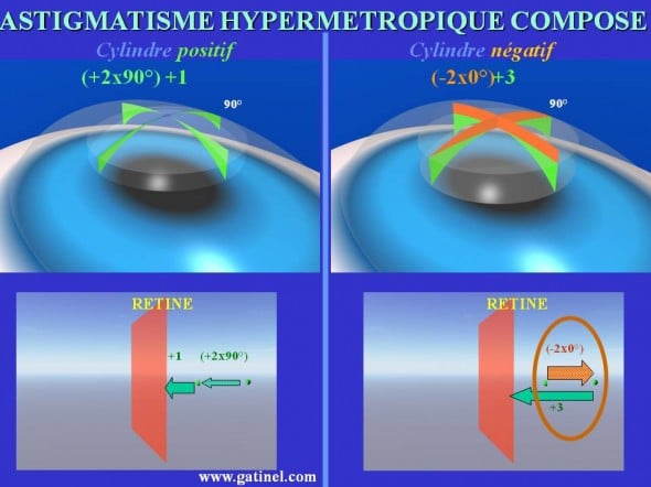 Astigmatisme hypermétropique composé cylindre positif cylindre négatif