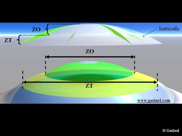 Lenticule et profil cornéen correction hypermétropie zone optique zone transition