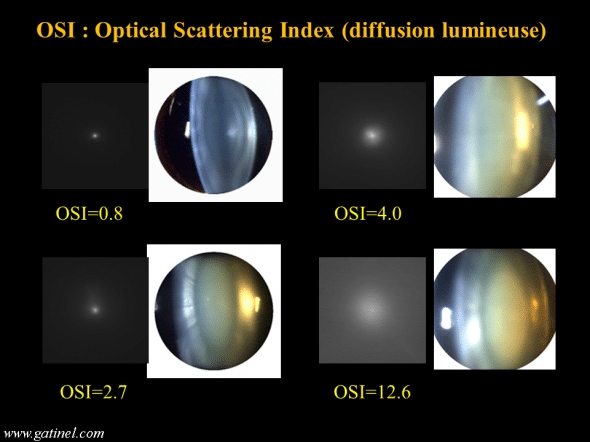 indice OSI, diffusion lumineuse et stades de cataracte