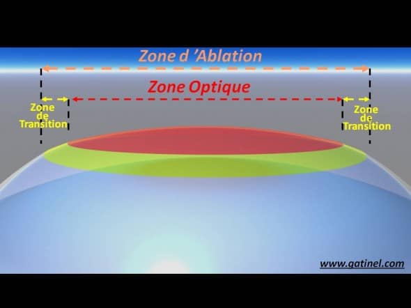 Zone d'ablation laser excimer PKR LASIK