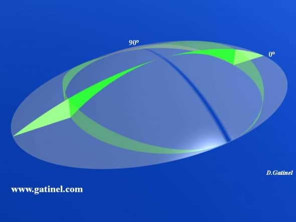 lenticule zone optique zone transition correction astigmatisme hypermétropique simple