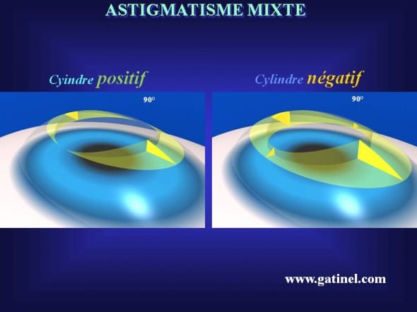 zone de transition stratégie cylindre positif négatif astigmatisme mixte