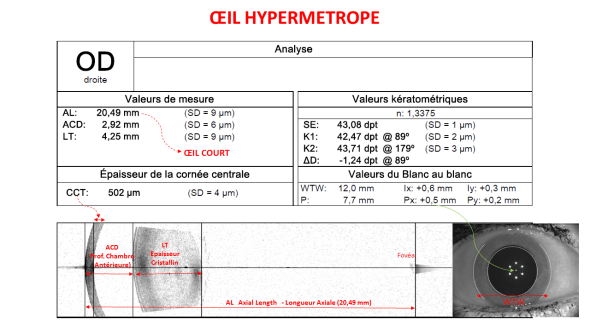 biométrie oeil hypermétrope