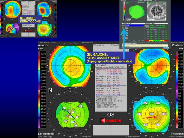 Topographie tomographie keratocone fruste