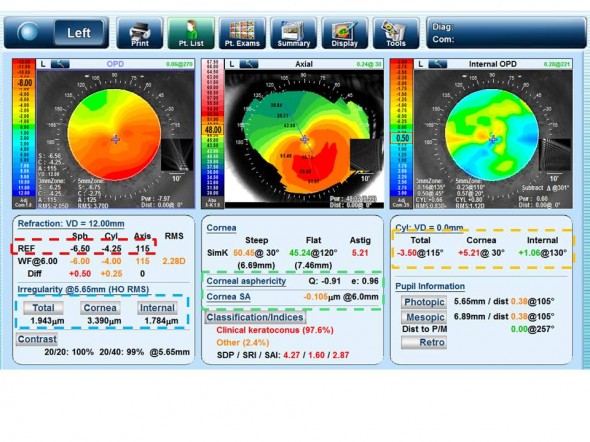 Keratocone OPD SCAN 3 Overview