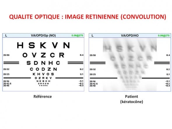 keratocone HOA convolution acuité