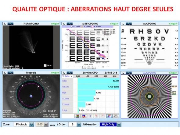 Keratocone qualite optique HOA MTF