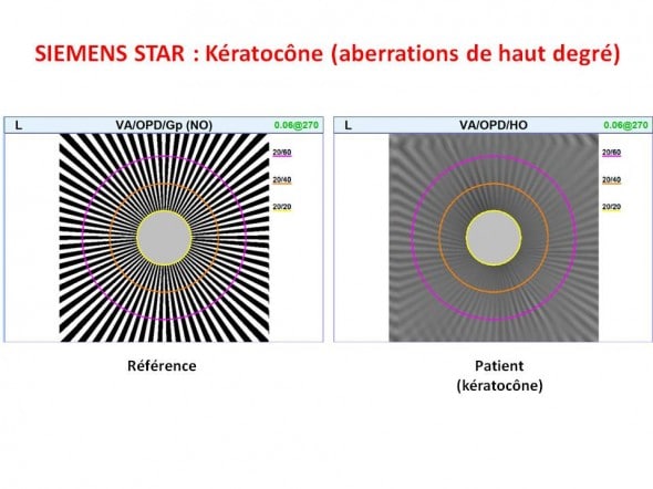 Keratocone siemens star HOA