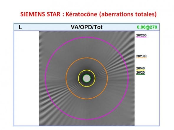 Keratocone siemens star aberrations totales