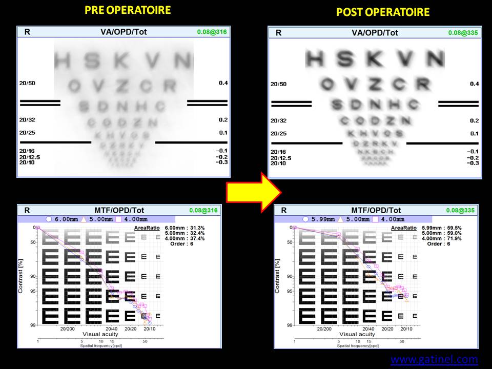 Carte Grader Tableau D'acuitu00e9 Visuelle Numu00e9rique Elite Lcd