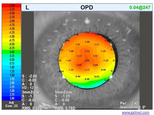 carte OPD recentrement reprise LASIK