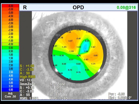 carte OPD réfraction locale dans la pupille cicatrice cornéenne astigmatisme irrégulier