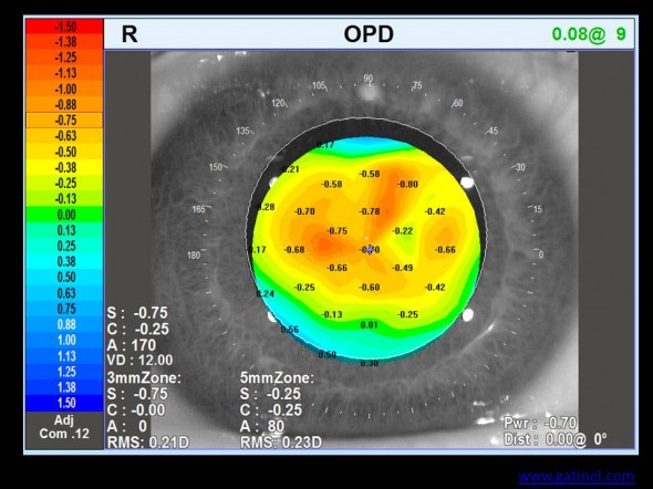 carte OPD réfraction locale dans la pupille postopératoire traitement customisé cornéoplastie