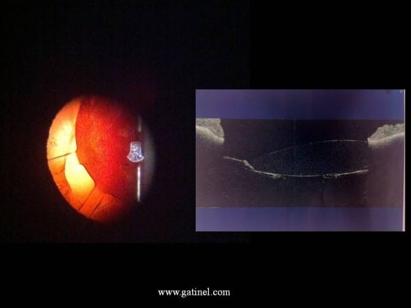implant décentré cataracte