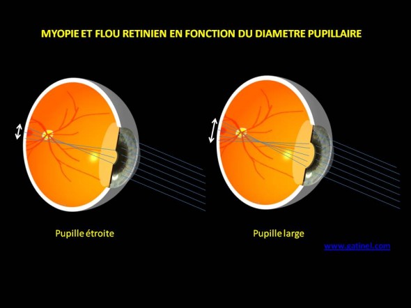 myopie flou rétinien diametre pupillaire