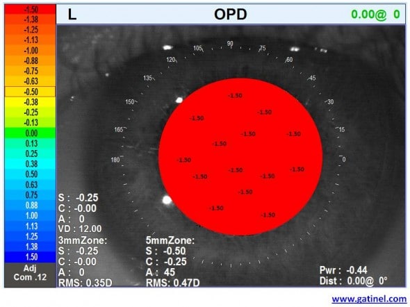 oeil myope carte OPD SCAN de vergence