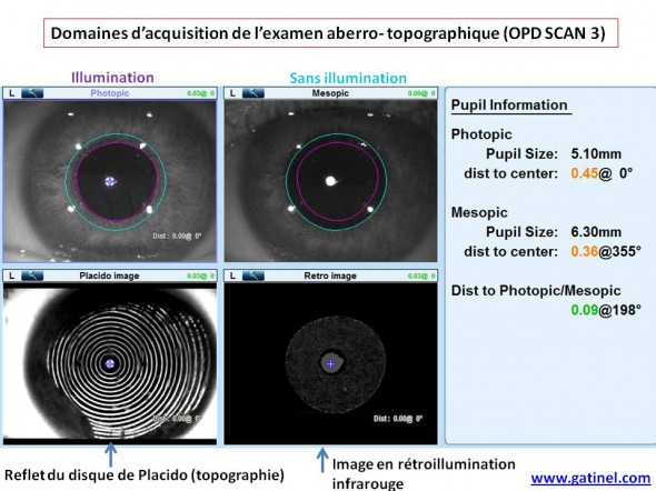 oeil normal acquisition aberro topographique