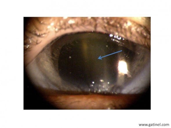 opalescence cataracte débutante