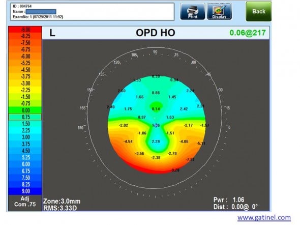 carte OPD HO dégénérescence pellucide marginale