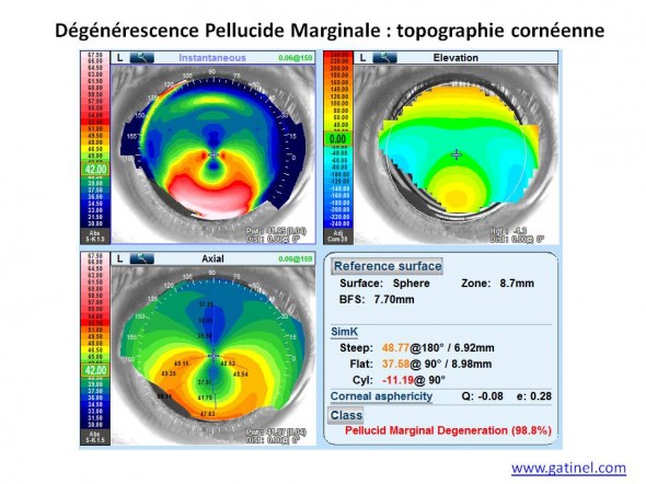 dégénérescence pellucide marginale topographie