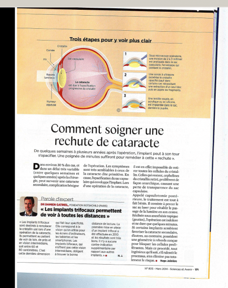 Cataracte secondaire Sciences et Avenir