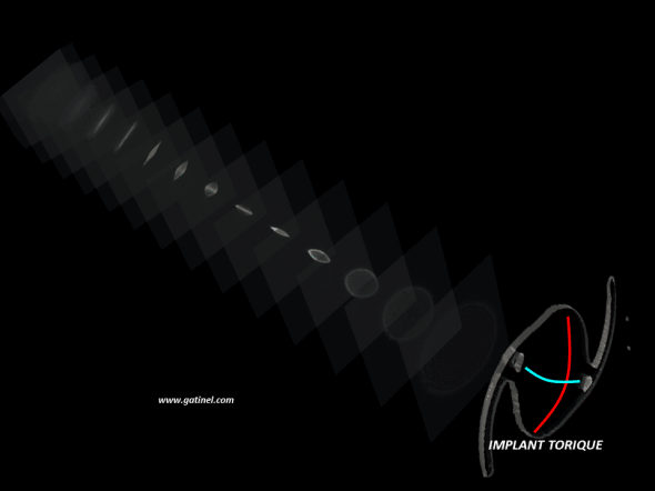 implant torique et lumière réfractée