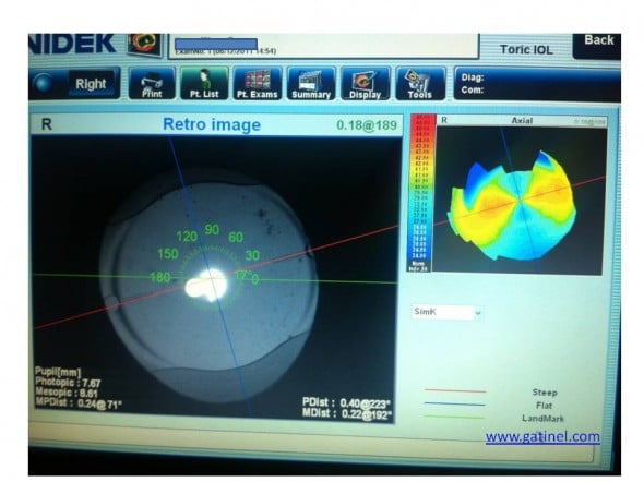 implant torique OPD SCAN III toric IOL display