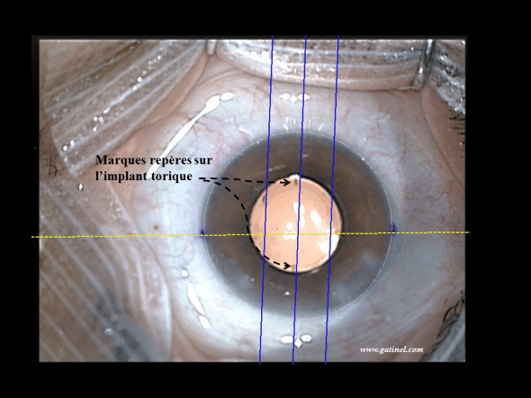 alignement implant, callisto