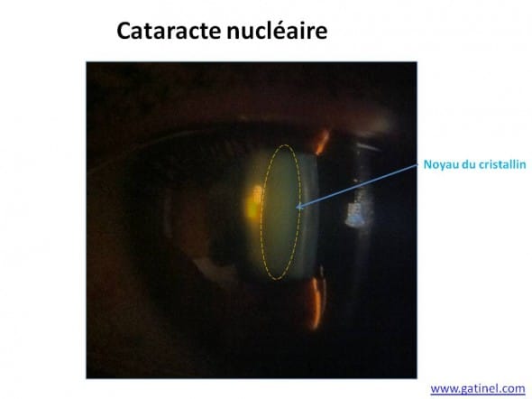 cataracte nucleaire myopie d'indice