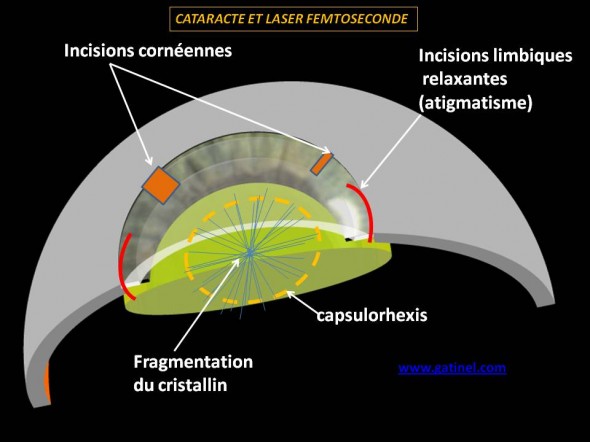 cataracte et laser femto seconde