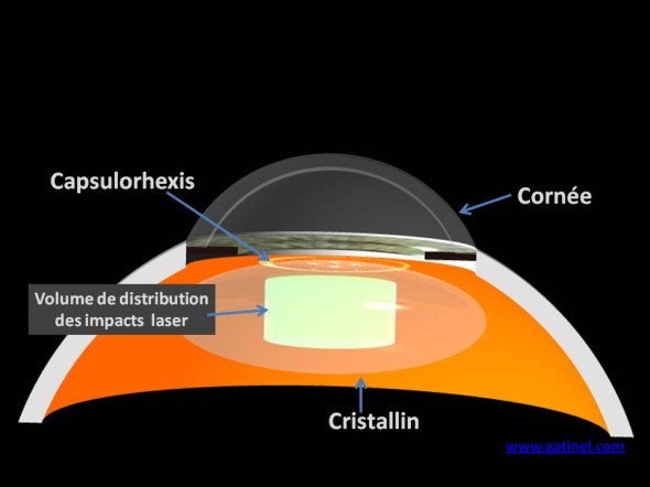 laser femtoseconde cataracte