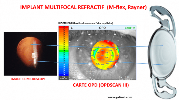 implant M flex multifocal Rayner