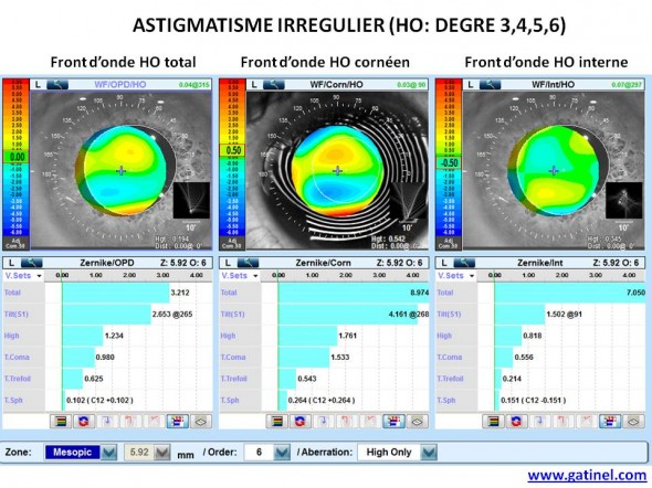 aberrations haut degré astigmatisme irrégulier HOA