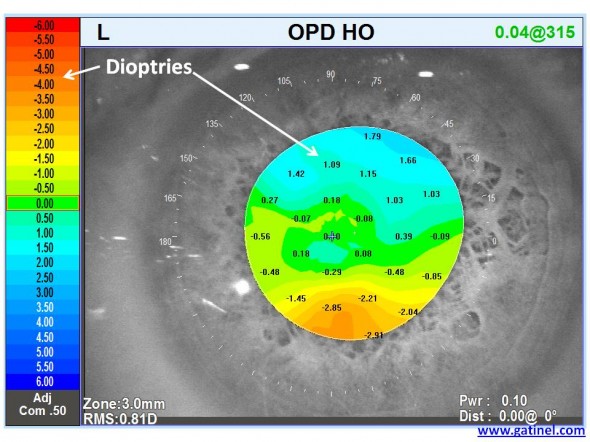 carte OPD HO implant torique astigmatisme irrégulier