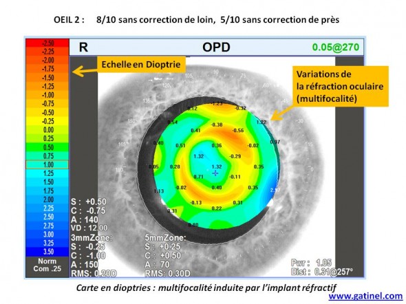 carte OPD multifocalité