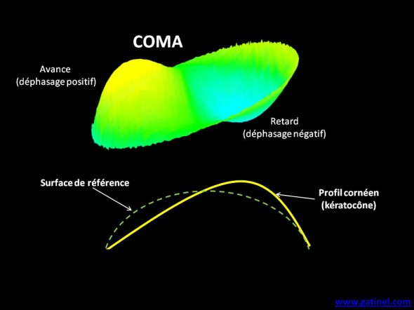 aberration coma keratocone