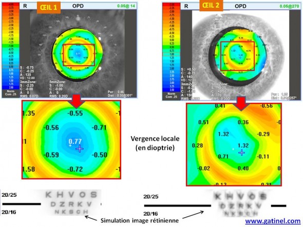 carte Nidek OPD vergence multifocal