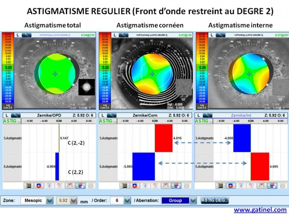 composant zernike astigmatisme compensation implant torique