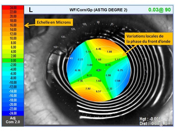 déphasage implant torique front d'onde cornéen