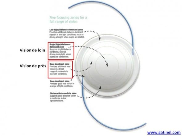 implant multifocal rétractif rezoom