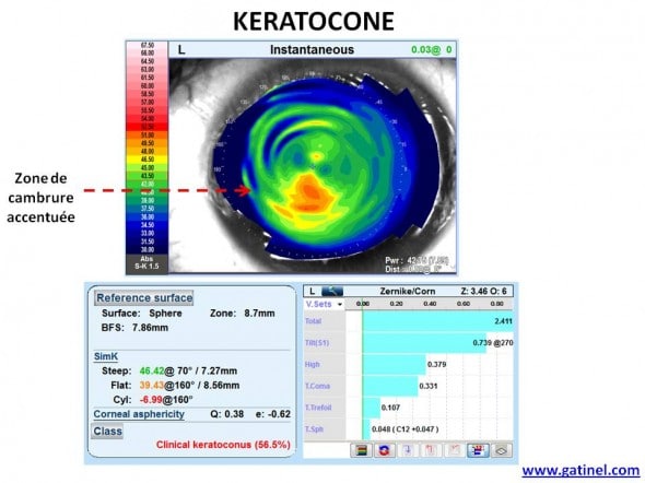 keratocone topographie OPD SCAN III Nidek