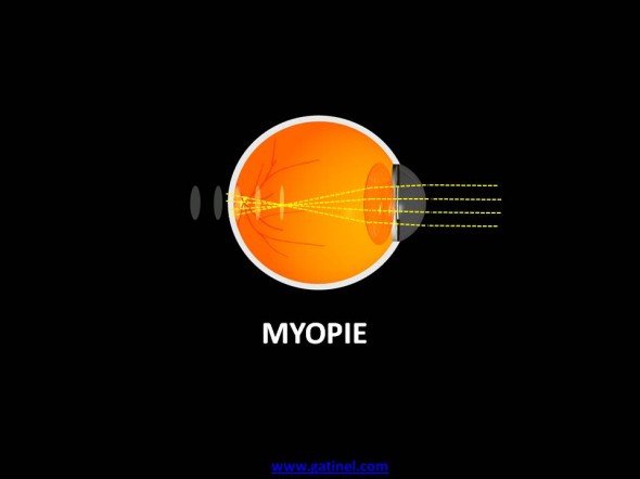 myopie 