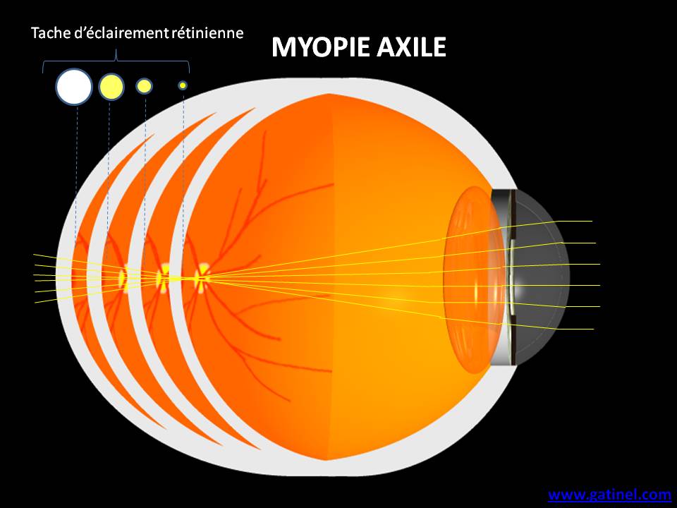 Miopie - Află totul despre cauze, simptome și tratament - Vitreum - Centru medical oftalmologic