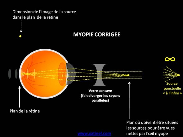 myopie corrigée schéma